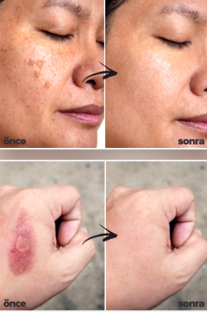 Etkili Çil Leke Benek Kremi