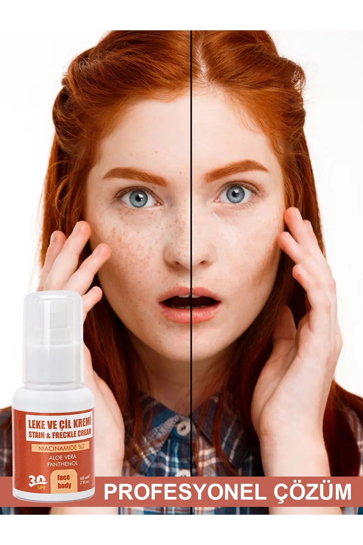 Etkili Çil Leke Benek Kremi